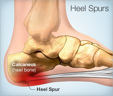 Heel spur | causes & treatment