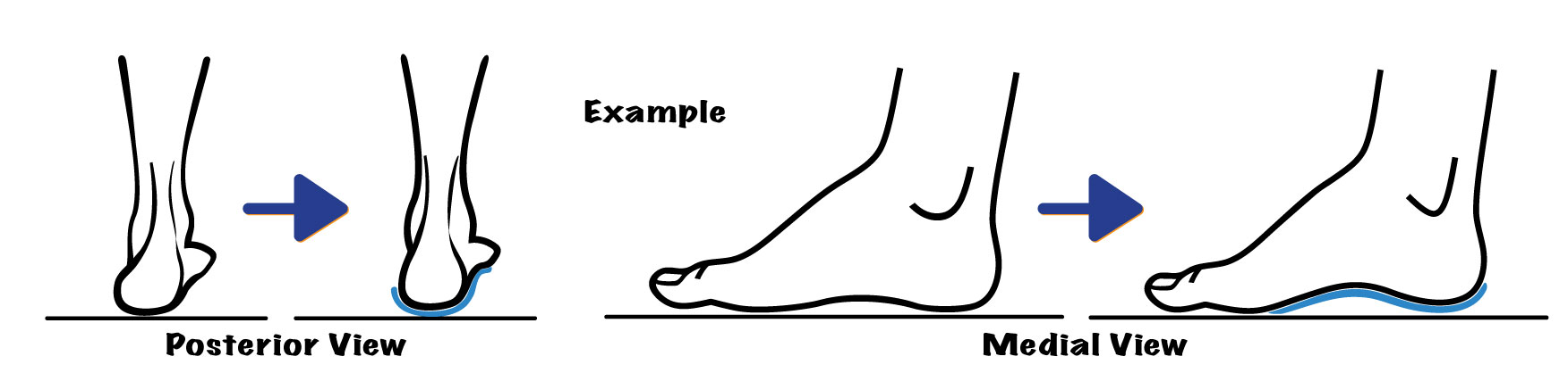 Image of orthotic supporting arch correctly