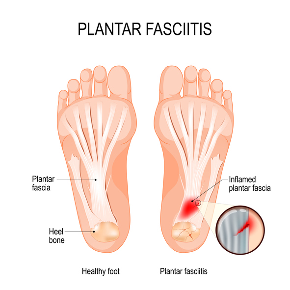1Pair Feet Heel Pain Relief Plantar Fasciitis Insole Run-up Pad Feet Sole CarSKU 